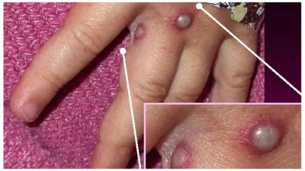 मंकीपक्सको संक्रमण बढ्दै, सचेत रहन डब्लुएचओको आग्रह