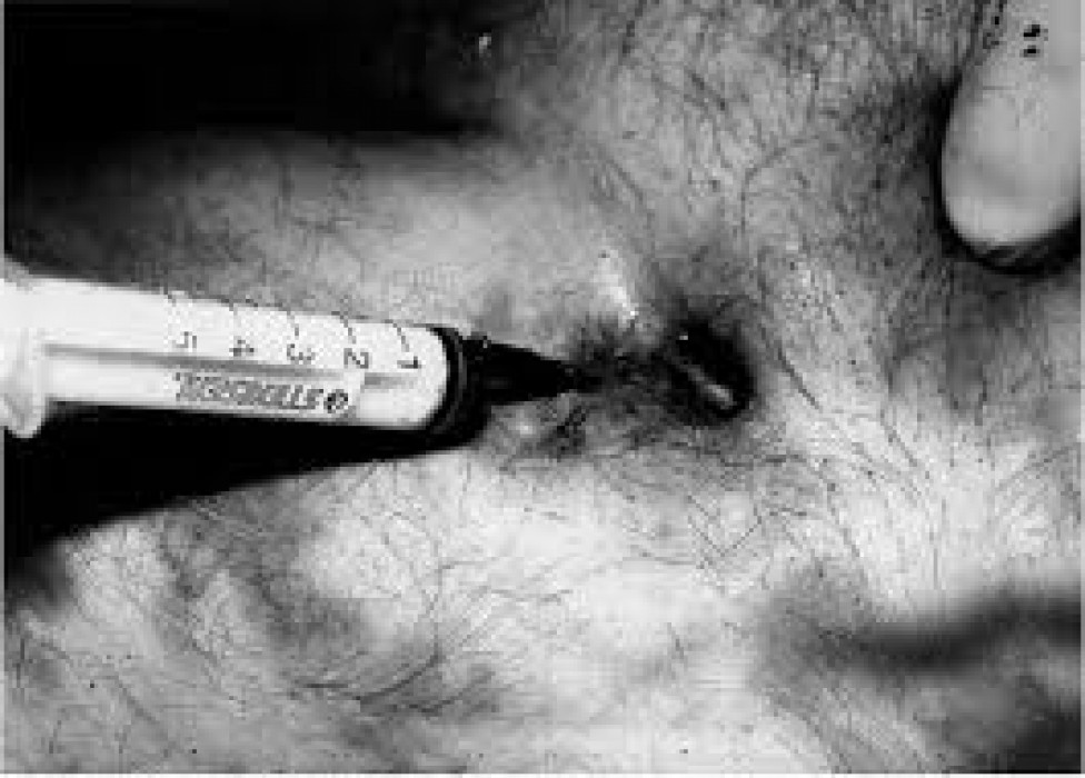 सहपाठीको बुवालाई सिरिञ्ज प्रहार गरि हत्या